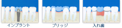 歯の無い所の治療法の選択