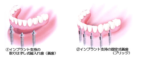 歯を何本か失った場合