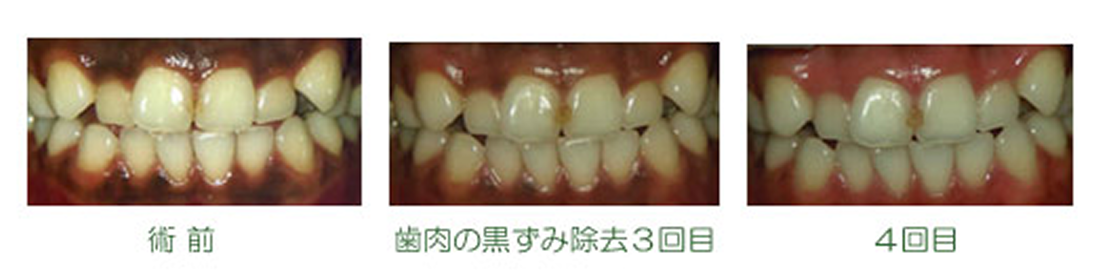 歯茎の黒ずみ除去　症例