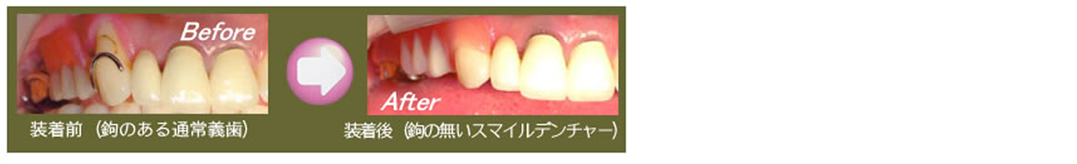 スマイルデンチャーの特長