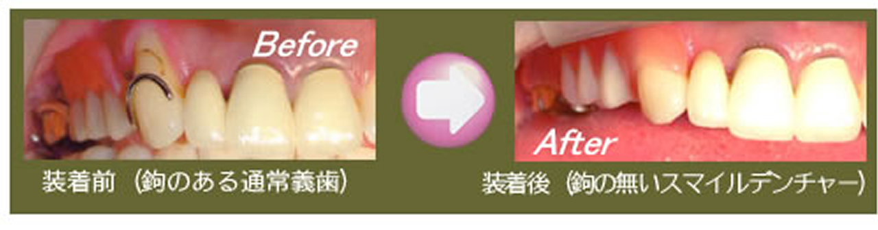 スマイルデンチャーの特長