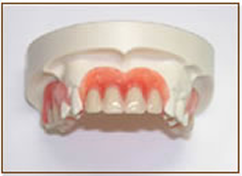 スマイルデンチャーの治療費