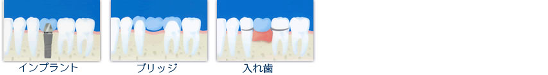 歯の無い所の治療法の選択