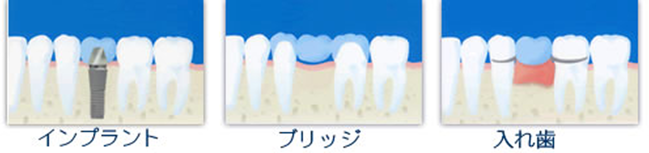 歯の無い所の治療法の選択