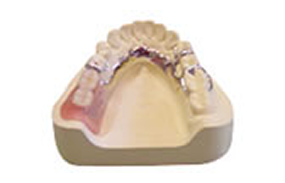 金属床（超精密義歯）