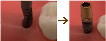 器具で歯茎を骨から剝がして、骨面が直視できるようにする