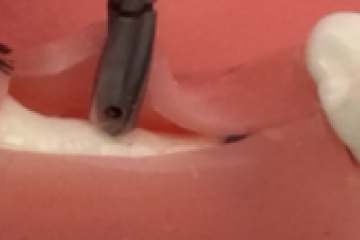 ドリリング → 埋入