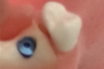 埋入後、キャップを歯茎の下に入れる２回法が多いため、4～6か月後の2次手術（再度，切開・縫合）が必要