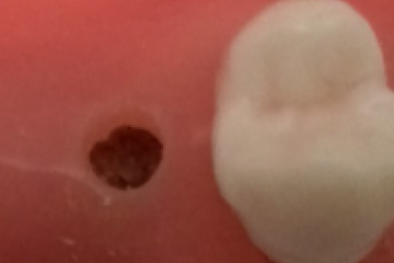 パンチ、バーなどで歯茎に小さい穴をあける