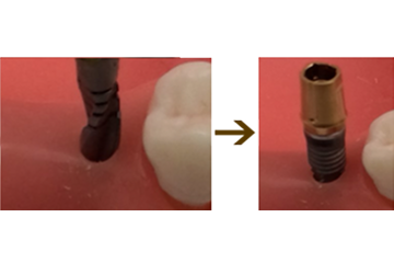 ドリリング → 埋入