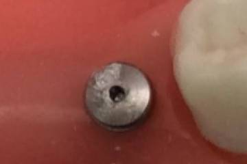 埋入後、キャップを歯茎の上に出す1回法が多いので、4～6か月後の2次手術（再度、切開・縫合）が不要な場合が多い