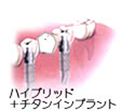 下の奥歯に２本埋入して上部構造は３本のブリッジ　価格重視・奥歯用を選択