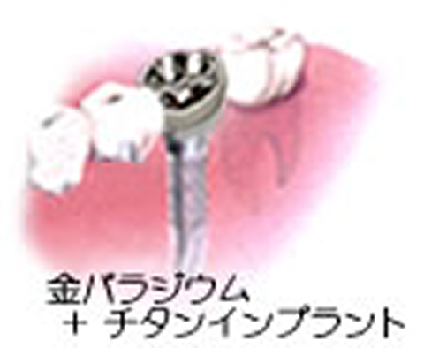 下の奥歯に１本埋入　価格重視・奥歯用を選択