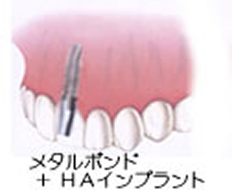 上の前歯に１本埋入　価格重視・前歯用を選択