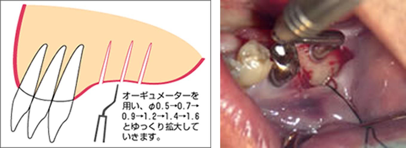 ドリルなしのインプラント「ＯＡＭインプラント」を使用(名古屋市立大学医学部講師 大口弘医学博士考案)
