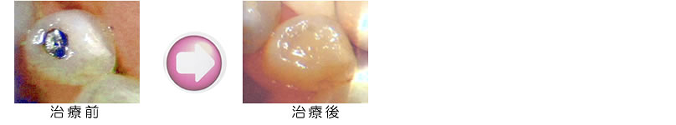 金属アレルギー