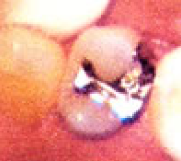 3Mix法を用いなくてもよい浅い虫歯