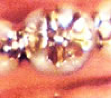 3Mix法を用いた深い虫歯