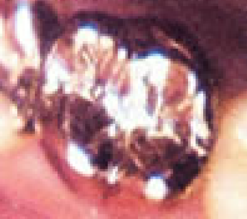 神経を処置したあとのかぶせ物