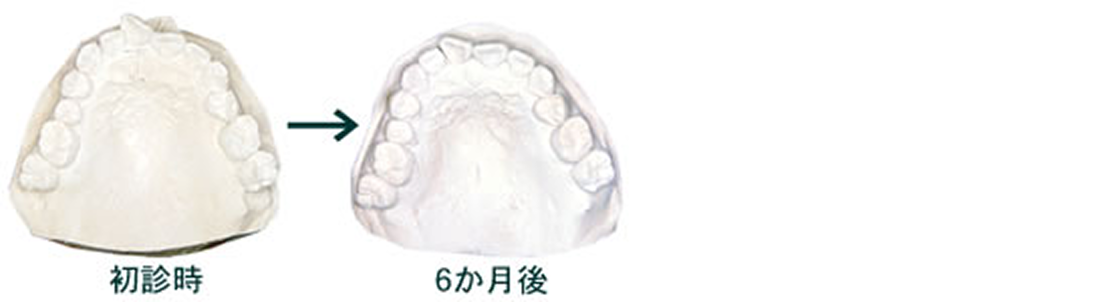 マウスピース矯正