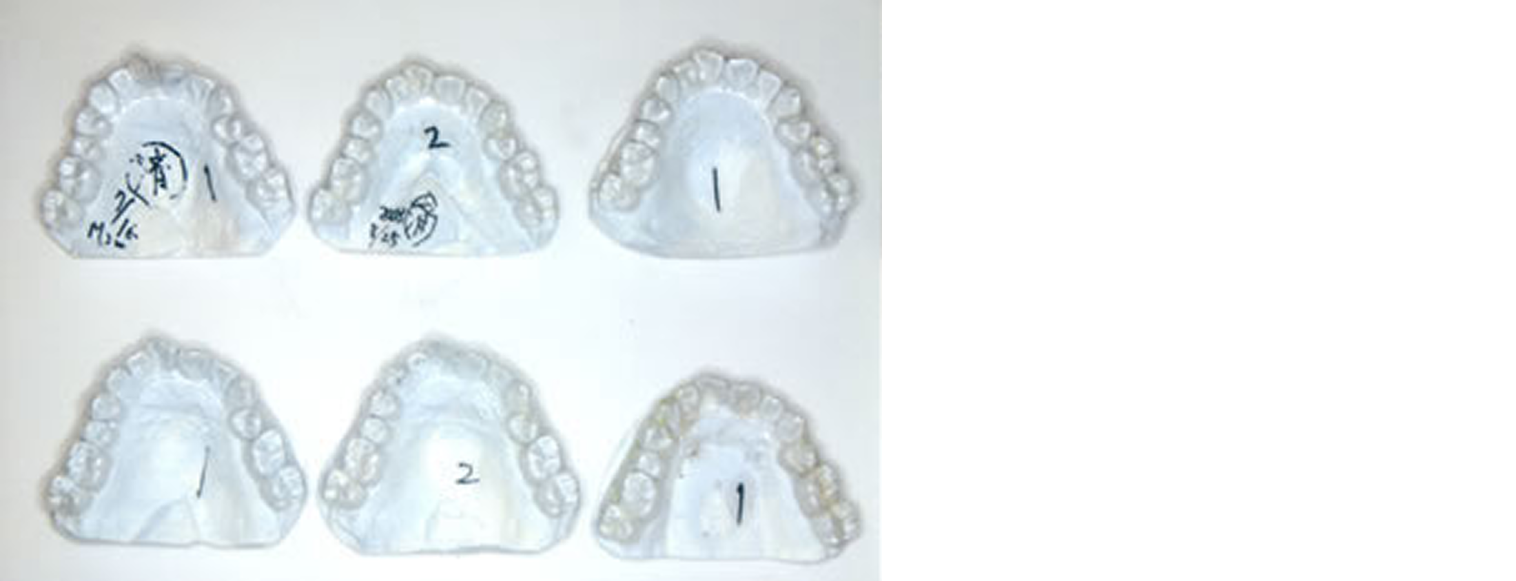 マウスピース矯正