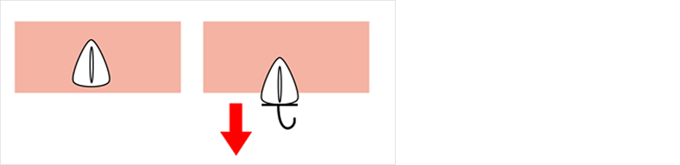 挺出（エキストルージョン）