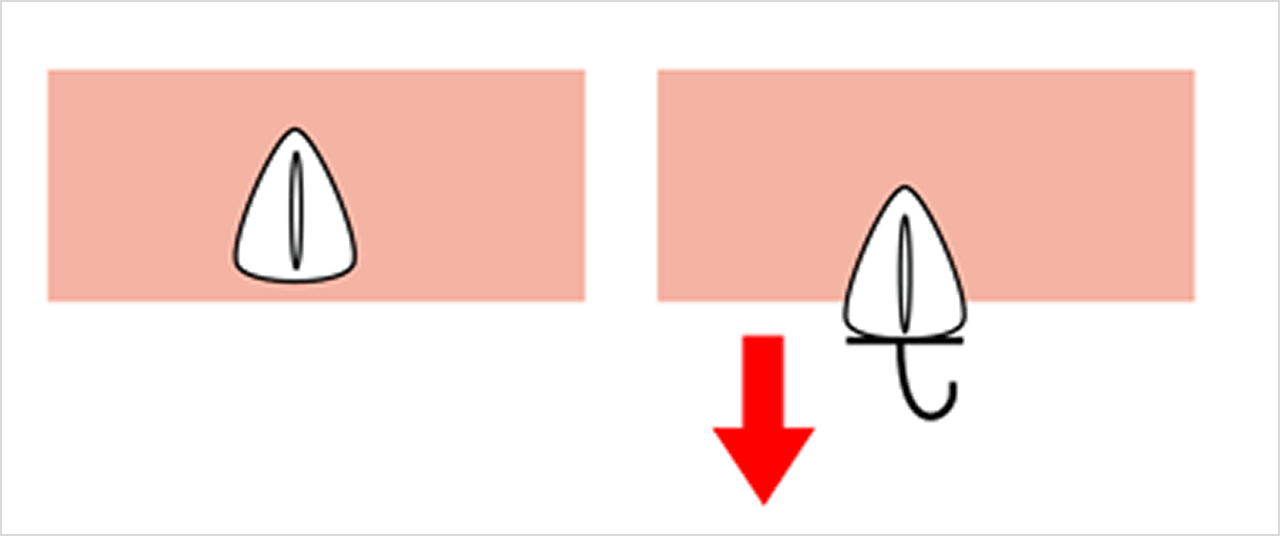 挺出（エキストルージョン）