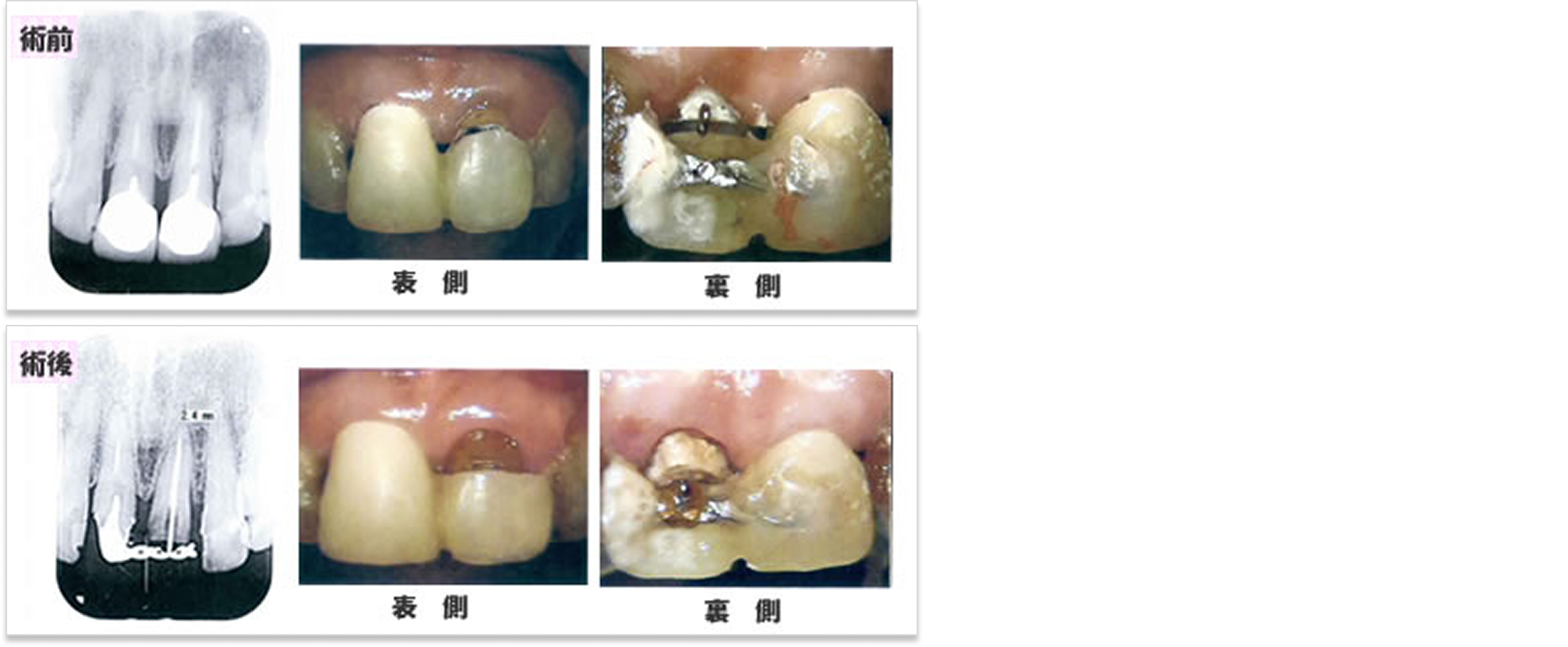 挺出（エキストルージョン）