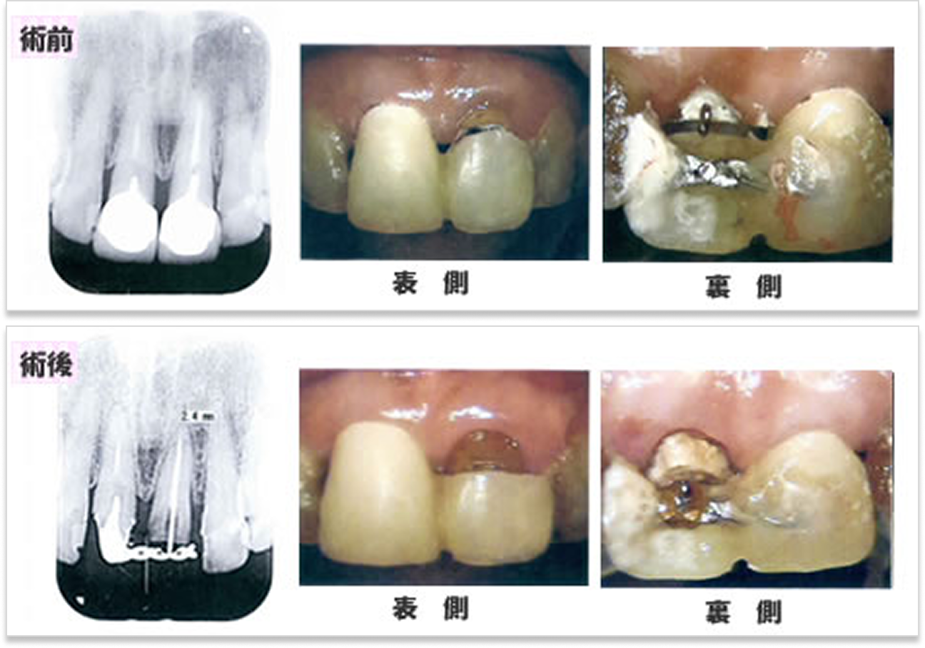 挺出（エキストルージョン）