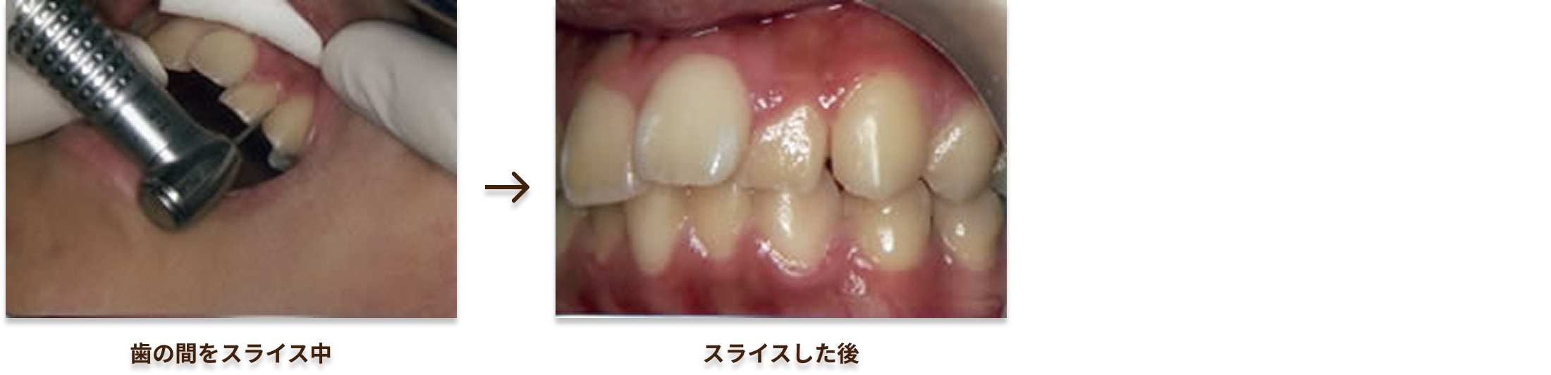 マウスピース矯正