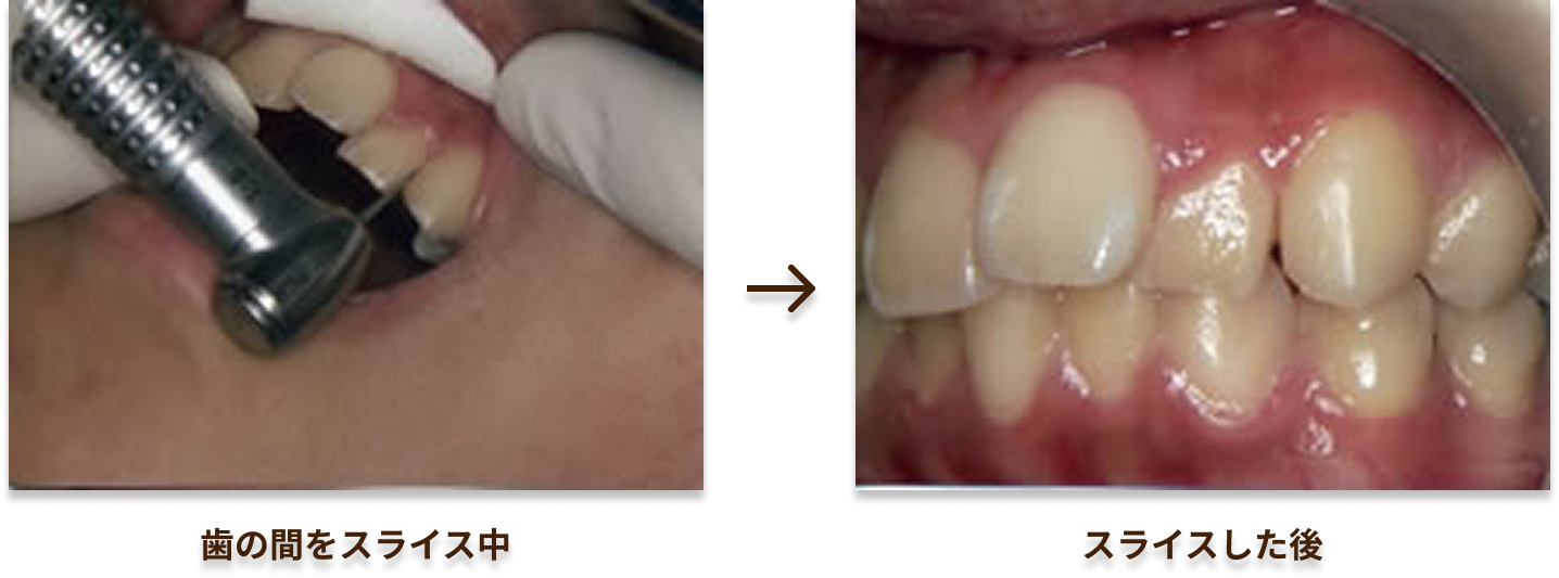 マウスピース矯正