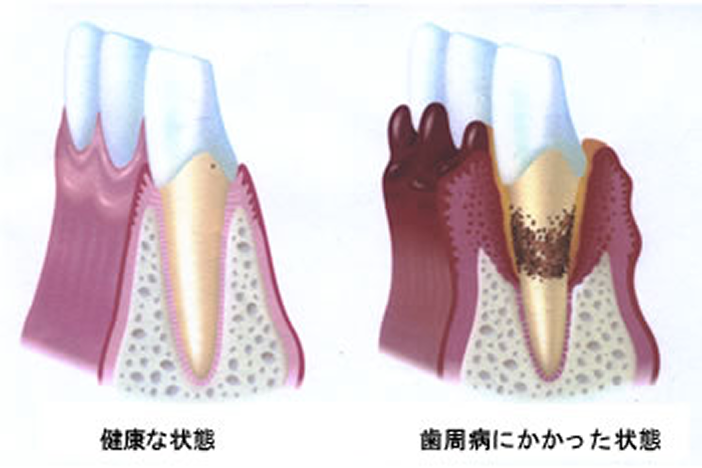 歯周病治療