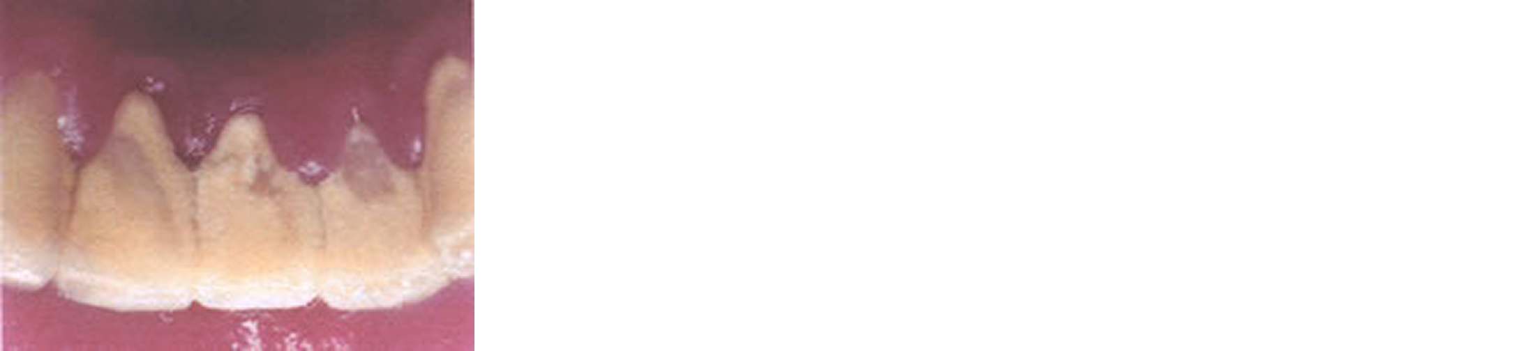 なぜ歯周病になるのでしょうか？