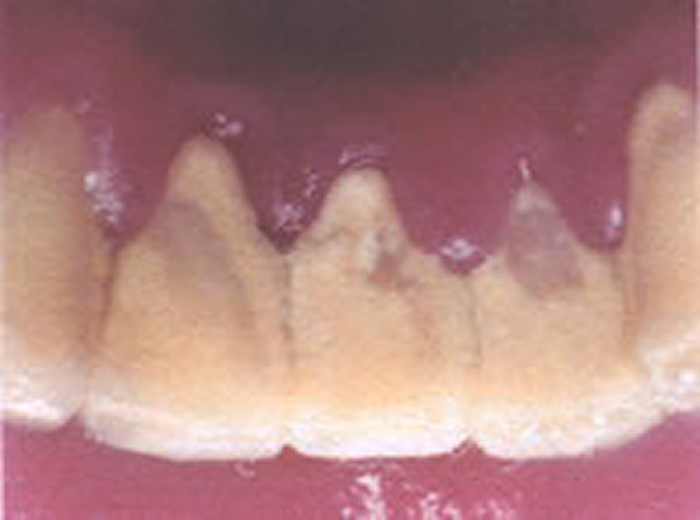 なぜ歯周病になるのでしょうか？