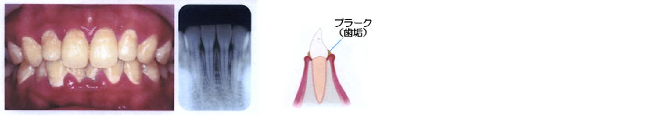 歯肉炎～軽度の歯周炎歯周病原菌
