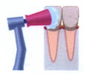 超音波による歯石除去