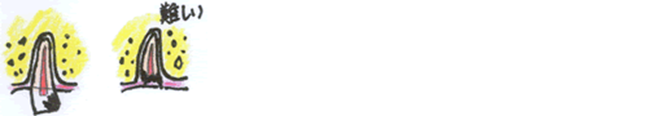 抜く時期が遅れると･･･