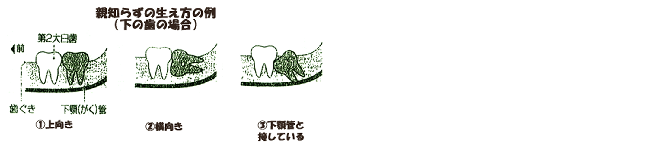 親知らずの抜歯が難しい理由