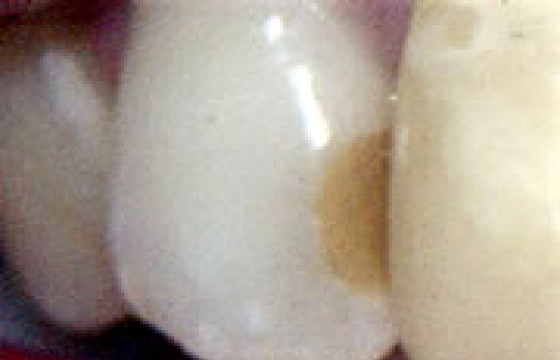 コンポレットレジン