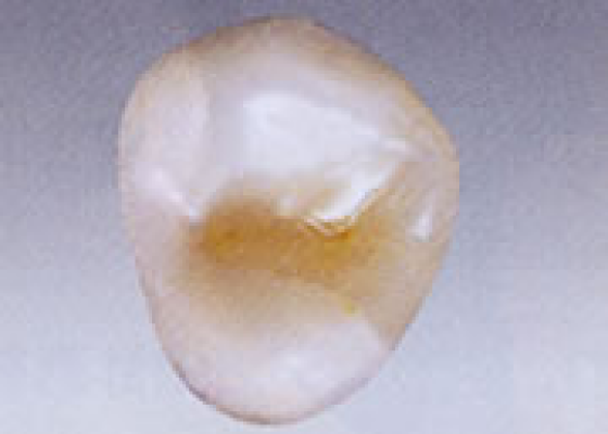 オールセラミックス（Ｅ－ＭAX)インレー