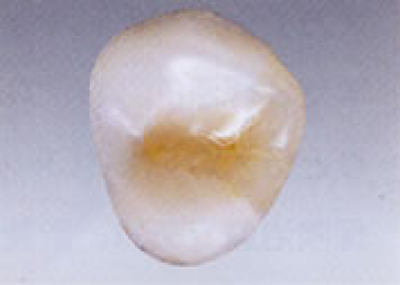 ハイブリッドセラミックス～ハイブリッドインレー（グラディア）