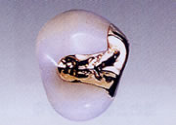 金合金（ゴールドインレー）