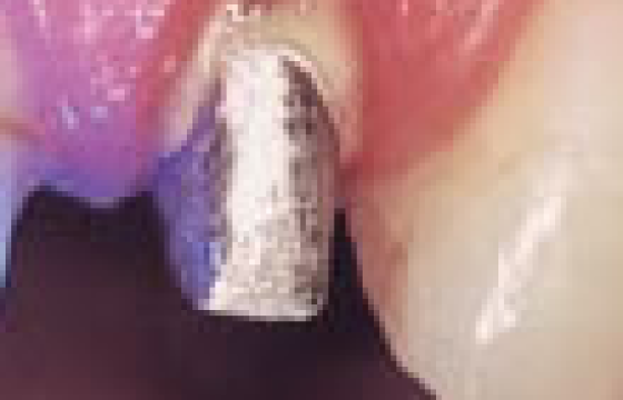 メタルコア（銀合金）