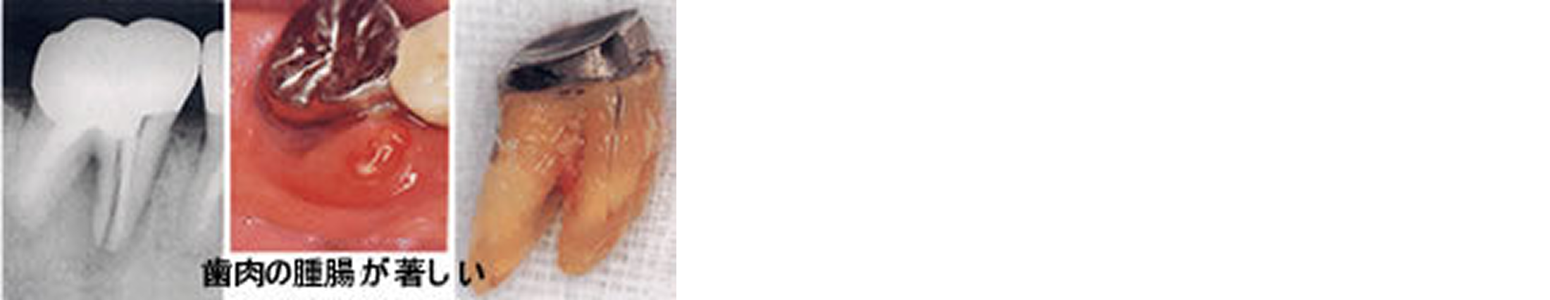 メタルコア（銀合金）