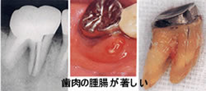 メタルコア（銀合金）
