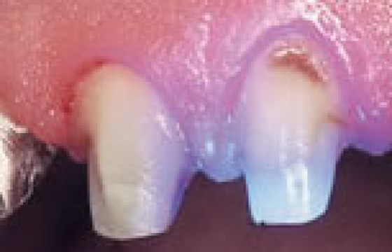 レジンコア（プラスチック）