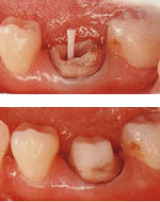 ファイバーコア（グラスファイバー製）
