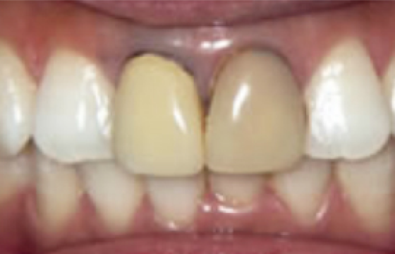 硬質レジン前装冠