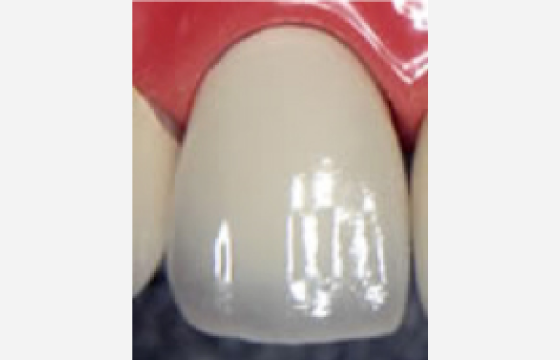 メタルボンドクラウン