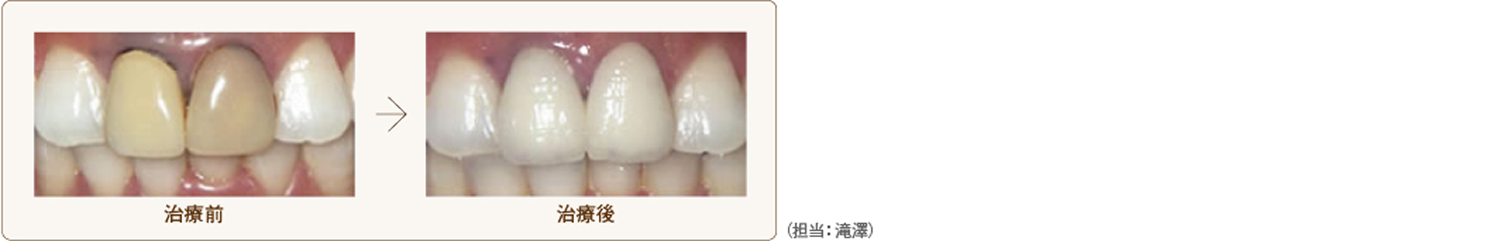 メタルボンドクラウン